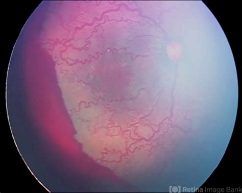 Aggressive Posterior Retinopathy Of Prematurity AP ROP Retina Image