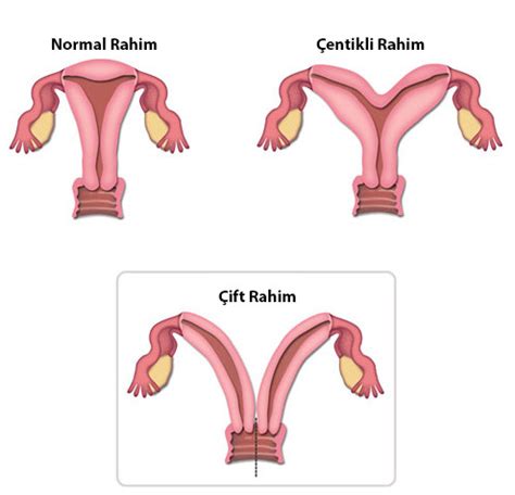 Çift Rahim Nedir Neden Olur Tüp Bebek Tedavisi Dr Ali Osman