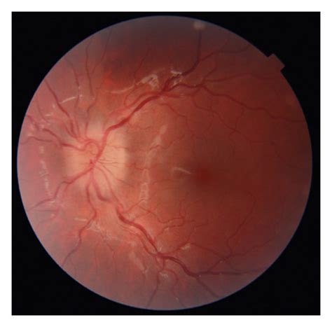 The Fundus Of The Right A And Of The Left B Eye At The Baseline