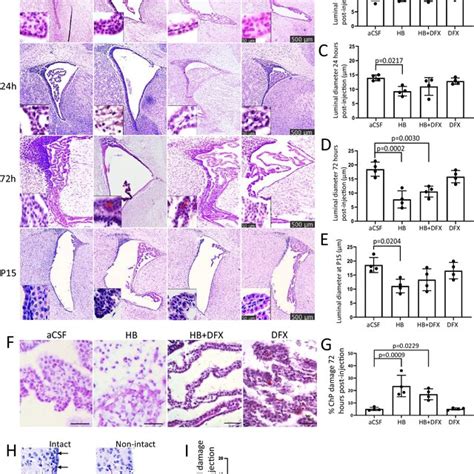 Iron Mediated Choroid Plexus Chp Dysfunction After Intraventricular