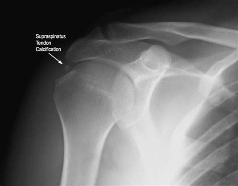 A Shoulder Radiograph With Mineralization Of The Supraspinatus Tendon ...