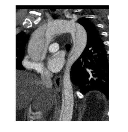 Imaging Case Of The Week 468 Answer Emergucate