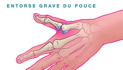 Entorse Grave Du Pouce Dr Eddy Becquet