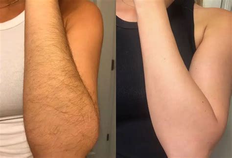 Laser Hair Removal Arms Before After Online Centralcountiesservices Org