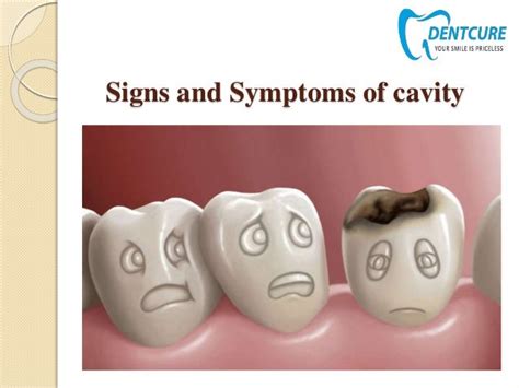 Signs and symptoms of cavity