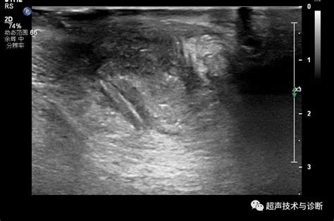 肛周脓肿的超声诊断（含报告）回声软组织直肠