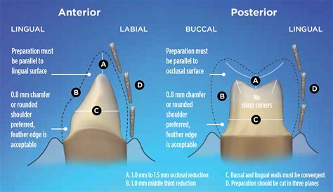 Zirconia Crowns Preparation