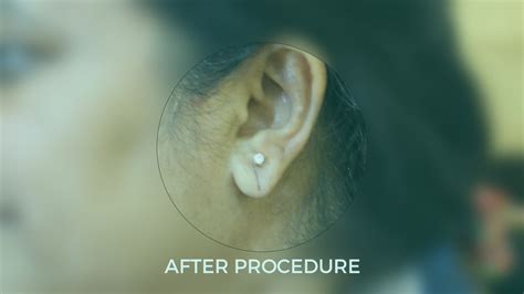 Ear Hole Repair | The Best Auroplasty Clinic In India