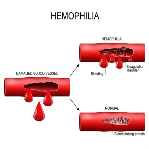 Monogenic Vs Polygenic: Traits, Examples, And Disorders