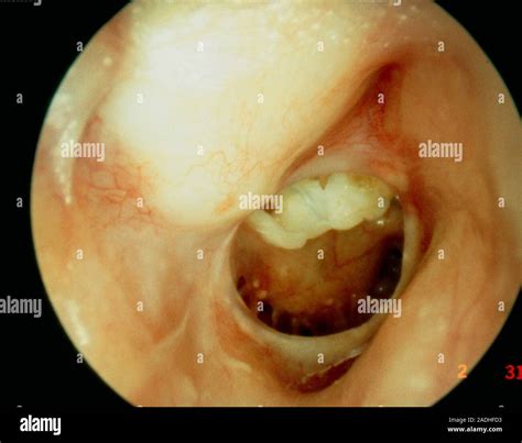 Perforated Eardrum A Very Large Perforation Reveals The Bony Wall Of