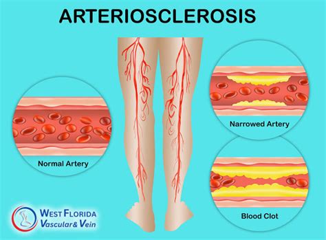 Tampa Peripheral Artery Disease Pad Treatment Safety Harbor