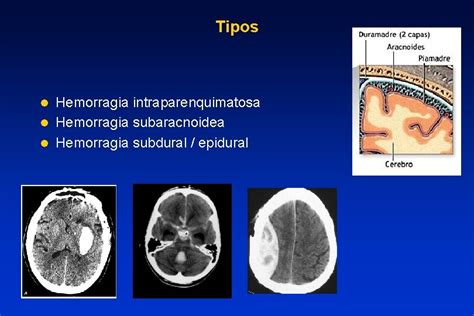 Enfermedades Vasculares Cerebrales Tema 3 Hemorragia Cerebral Definicin