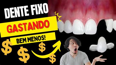 Prótese Barata EstÉtica E Fixa Pra Quem Perdeu Um Dente E NÃo Pode