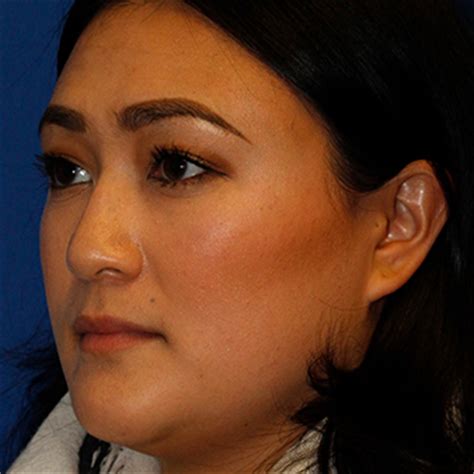 Ethnic Rhinoplasty | Seattle Facial Plastic Surgeon| Dr. Lamperti | Seattle, WA