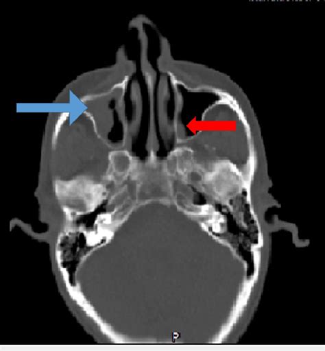 Axial Ct Head Showing Polypoidal Mucosal Thickening Of Right Maxillary