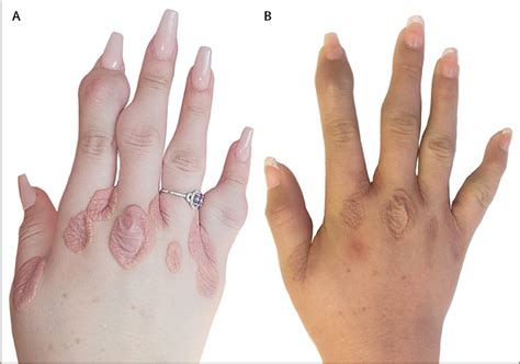 Xanthomata Of Hands