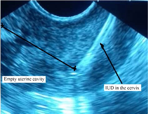 Intrauterine Displaced Iud Cervical Iud Download Scientific Diagram