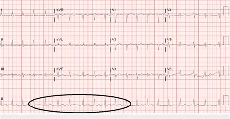 Electrocardiogram Showing Atrial Fibrillation With Rapid Ventricular Rate Download Scientific