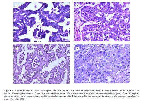 Clasificaci N Actual Del Carcinoma De Pulm N Consideraciones