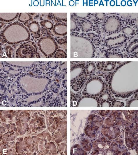 Figure 2 From Neonatal Iron Overload And Tissue Siderosis Due To