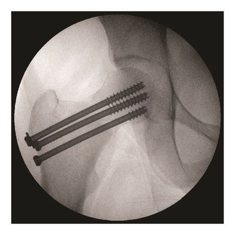 Intraoperative Views Of Valgus Intertrochanteric Osteotomy VITO