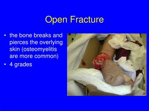 Grade 2 Open Fracture