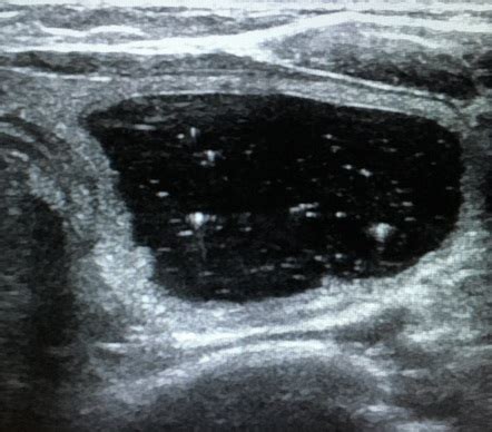 Colloid Nodule Thyroid Radiology Reference Article Radiopaedia Org