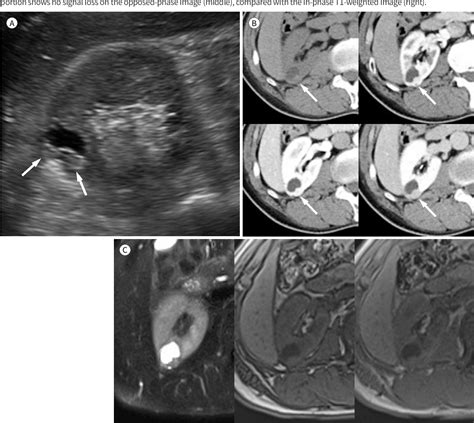 Figure 1 From Renal Epithelioid Angiomyolipoma With Epithelial Cysts