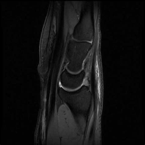 Wrist MR arthrogram