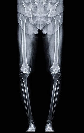 Full Lower Extremity Radiograph Including Hip Knee And Ankle Photo Background And Picture For