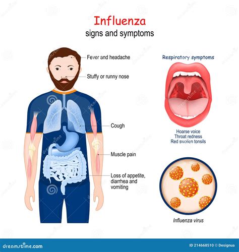 Influenza The Flu Stock Vector Illustration Of Runny 214668510