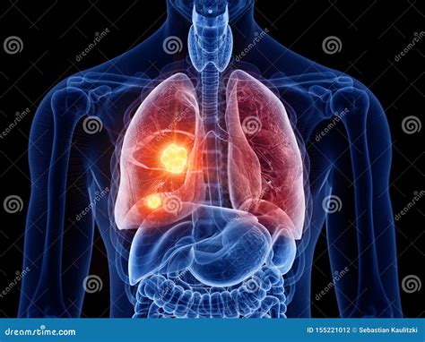 Lung Cancer Stock Illustration Illustration Of Accurate