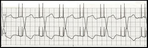 Basic EKG Rhythm Test 06