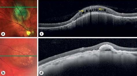 Table From Clinical And Spectral Domain Optical Coherence Tomography