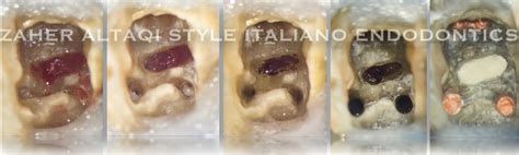 Perforation repair: step by step - Style Italiano Endodontics