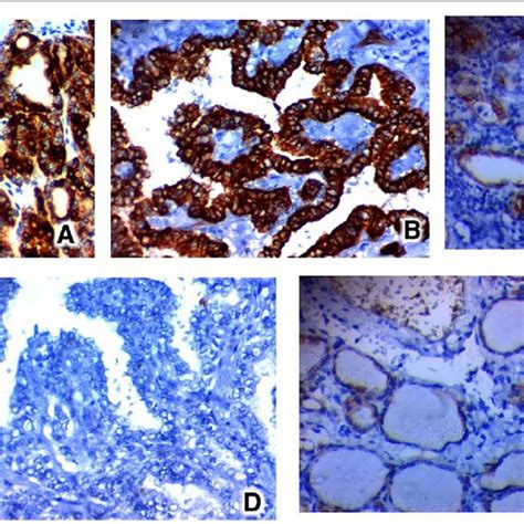 Immunohistochemical Expression Of Usp In Papillary Thyroid Carcinoma