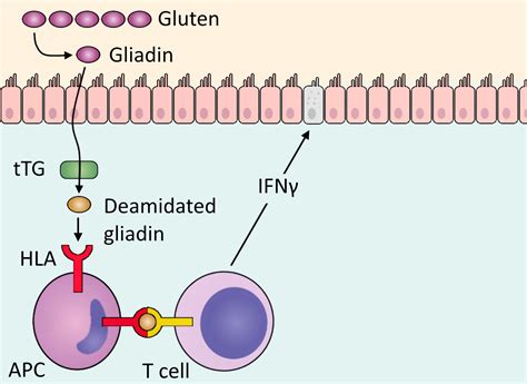 Coeliac Disease Overpath