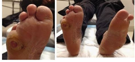 Diabetic Foot Ulcers — Treatment and Prevention | IntechOpen