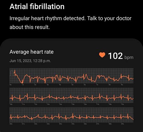 Samsung watch detected AFIB. Is this a false read? Been stressed ...