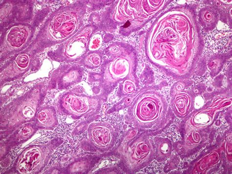 Squamous Cell Carcinoma Well Differentiated Shows Keratocysts