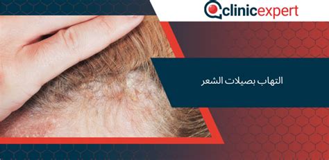 التهاب بصيلات الشعر Clinicexpert خدمات زراعة الشعر والرعاية الصحية