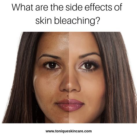 What Are The Side Effects Of Skin Bleaching Tonique Skincare