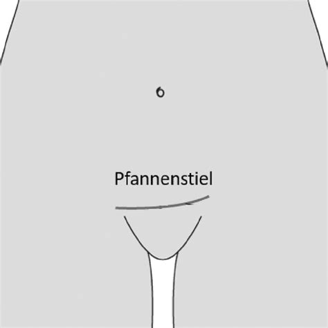 Pfannenstiel incision to access the abdomen. This figure is adapted ...