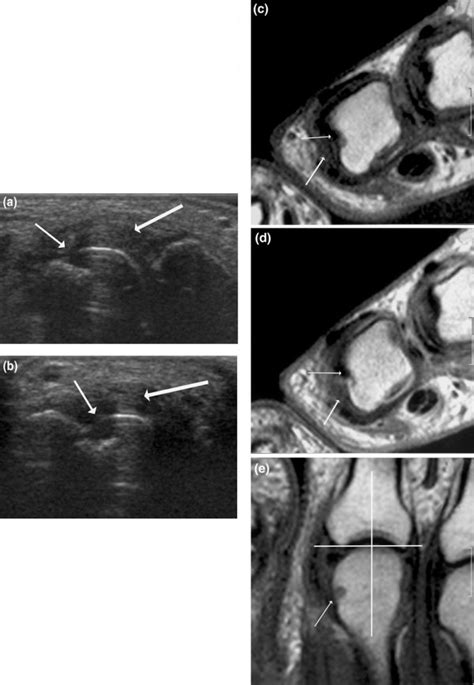 Signs Of Destruction And Inflammation On Ultrasonography And Mri In