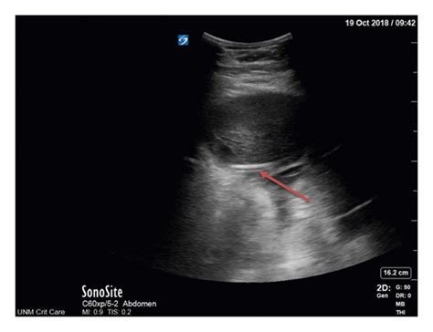 (a) Portable abdominal ultrasound showing complex intra-abdominal fluid ...