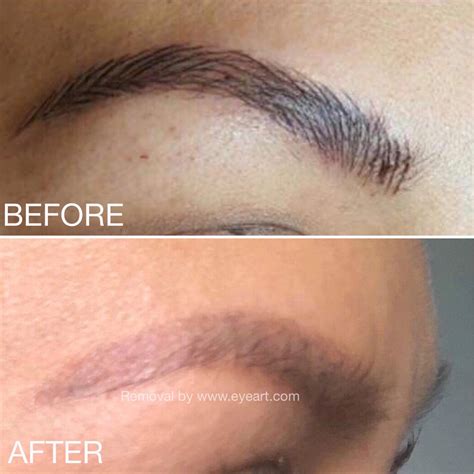 Eyebrow Tattoo Removal - Remove Botched Eyebrow Tattoo Immediately - Eye Art Studio