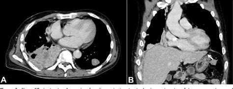 Figure 3 From Hepatoid Adenocarcinoma Of The Lung Mimicking Metastatic