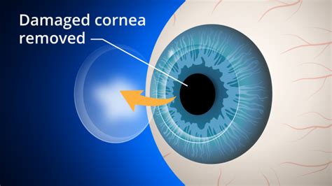 Cornea Transplant Corneal Graft Dsek Or Penetrating Keratoplasty