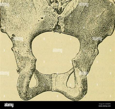 Dystocia pelvis hi-res stock photography and images - Alamy