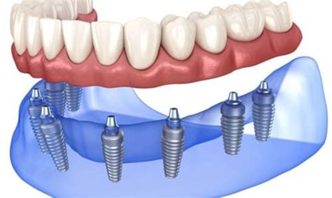 Prix Du All On En Turquie Implants Dentaires Implant Dentaire